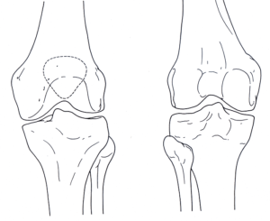 The Best Knee Specialist In San Jose | Dr. Pamela Mehta, MD