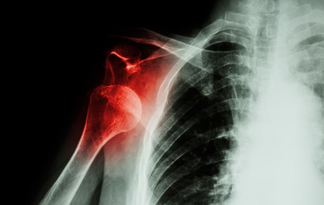 Shoulder Dislocation A Complete Guide Dr Mehta San Jose