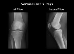 ACL Tear Treatment In San Jose, CA | Dr. Pamela Mehta, MD