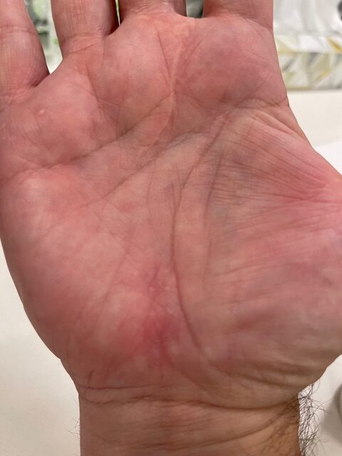 Carpal Tunnel Scar completely healed