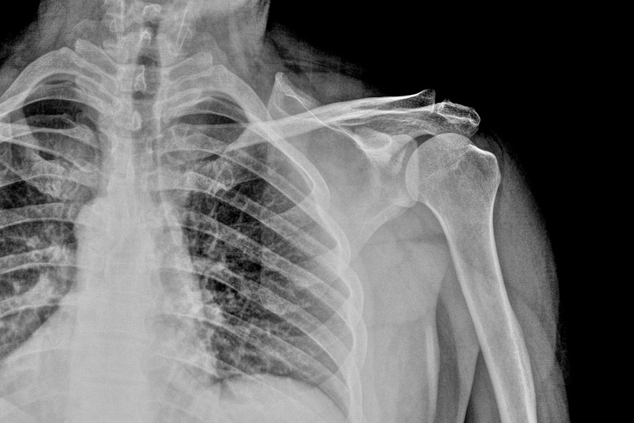 x-ray of the shoulder