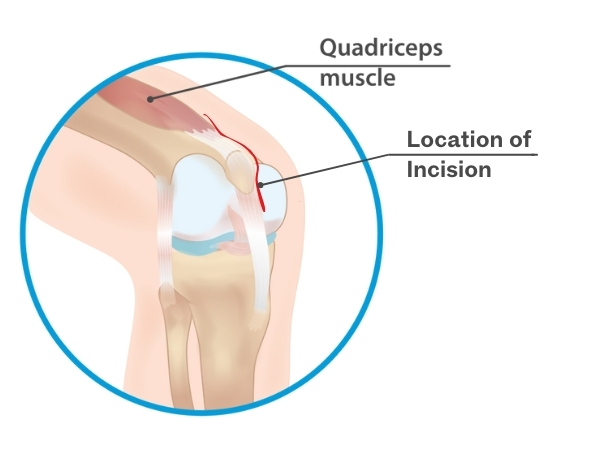 minimally invasive (quad sparing) knee replacement diagram