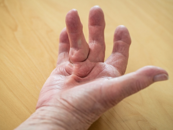 severe dupuytren's contracture