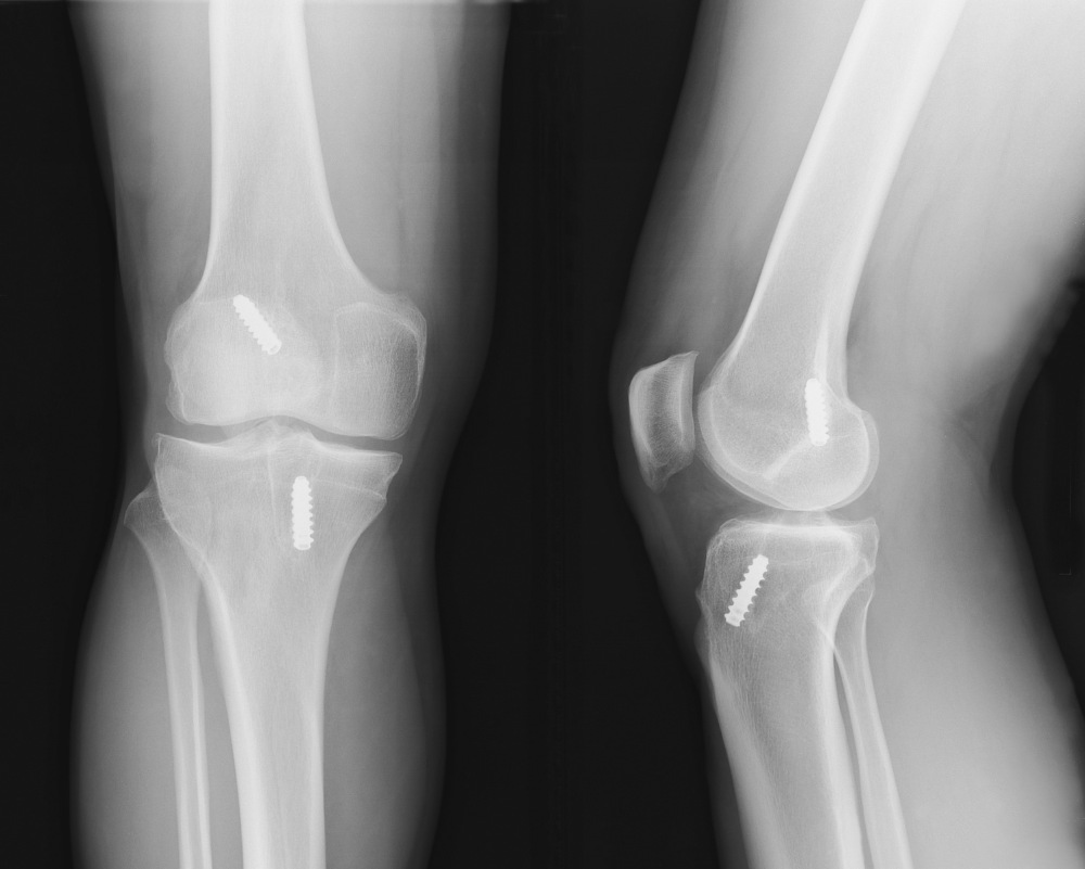 X-ray of knee after ACL reconstruction