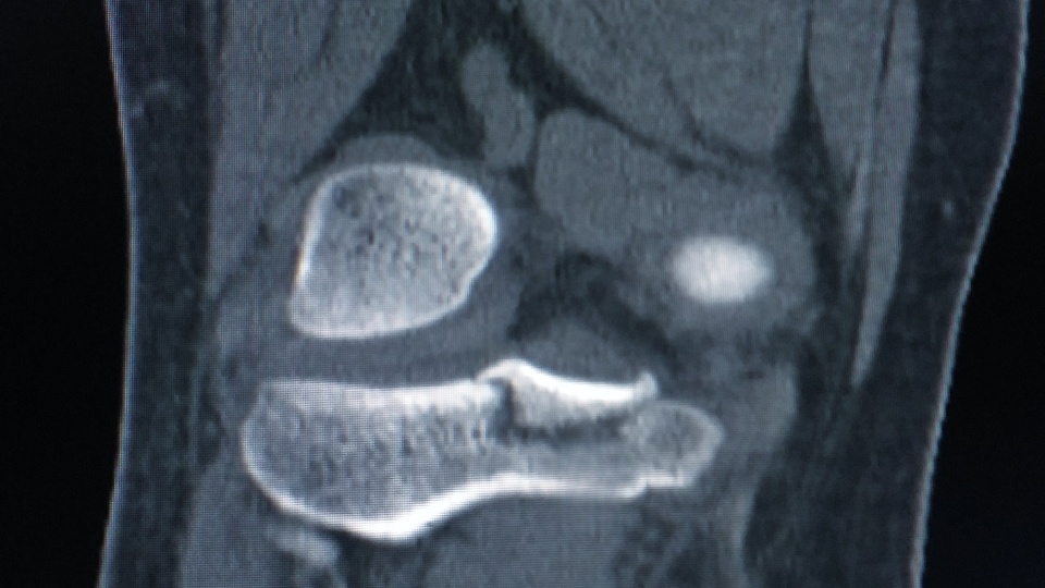 knee fracture MRI