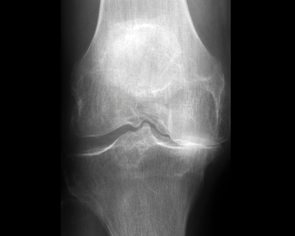 x-ray of knee with osteoarthritis