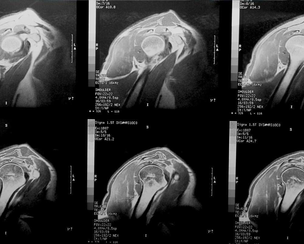 MRI showing rotator cuff