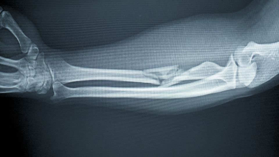 compound proximal radius fracture