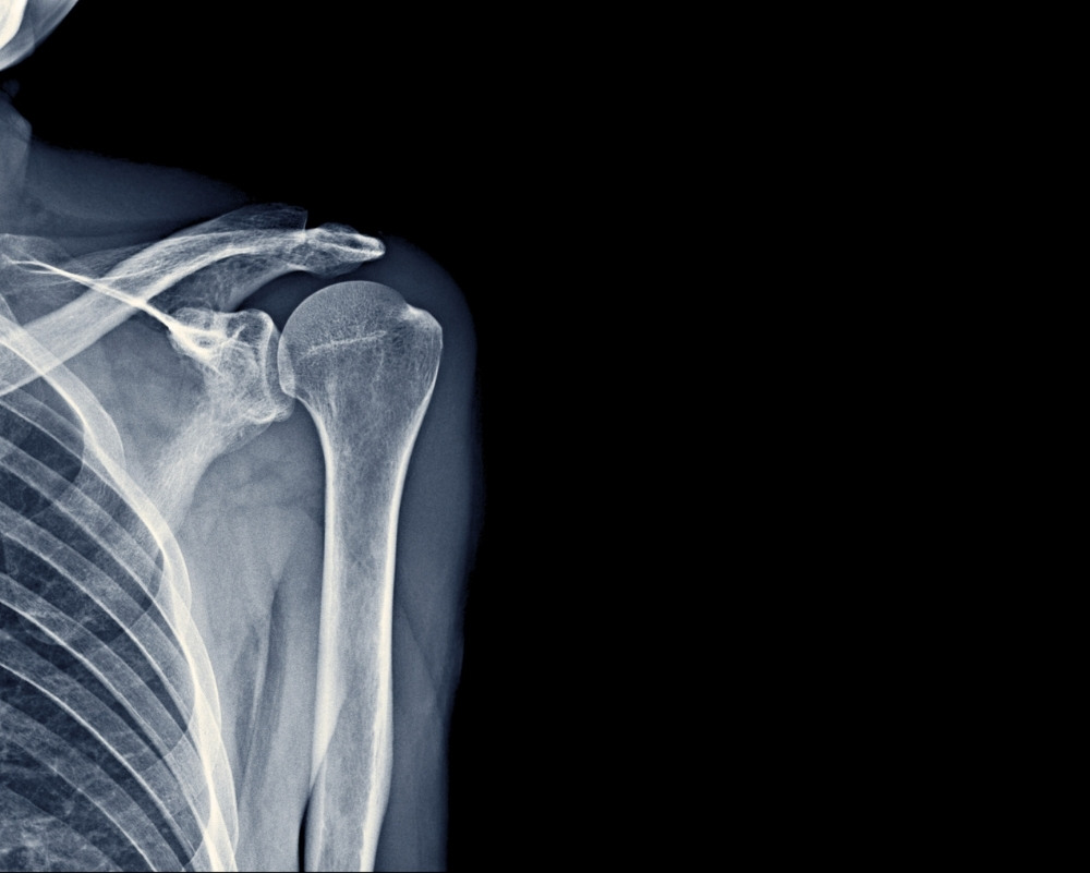 shoulder x-ray