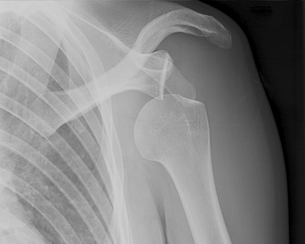 x-ray showing anterior dislocation